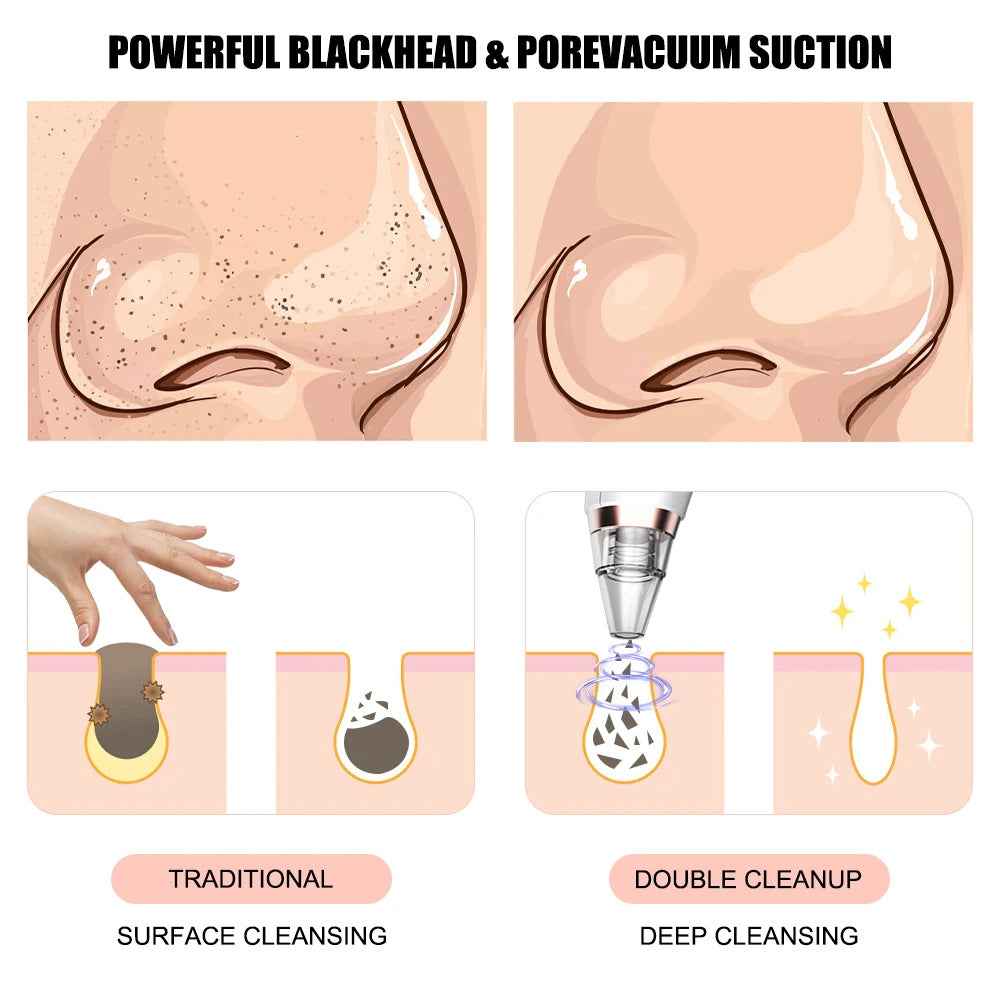 Blackhead remover