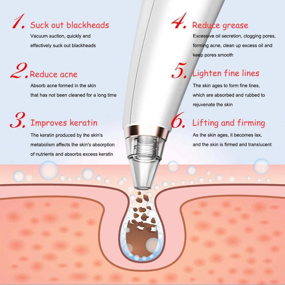 Blackhead remover